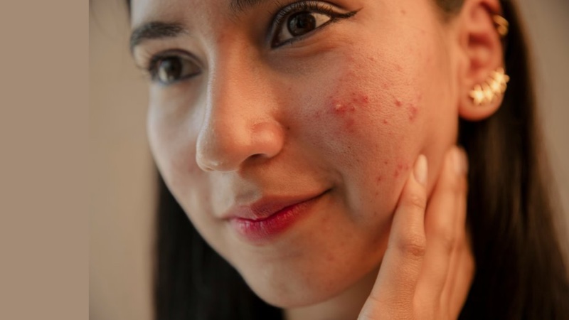 Acne treatment Brandon FL