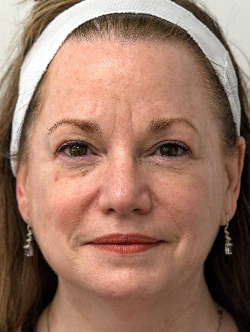 Before BBL, rosacea and redness