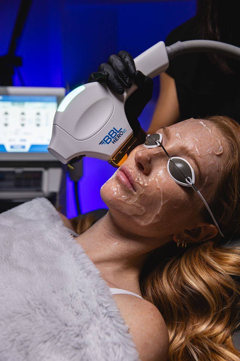 BBL HEROic light therapy treatment