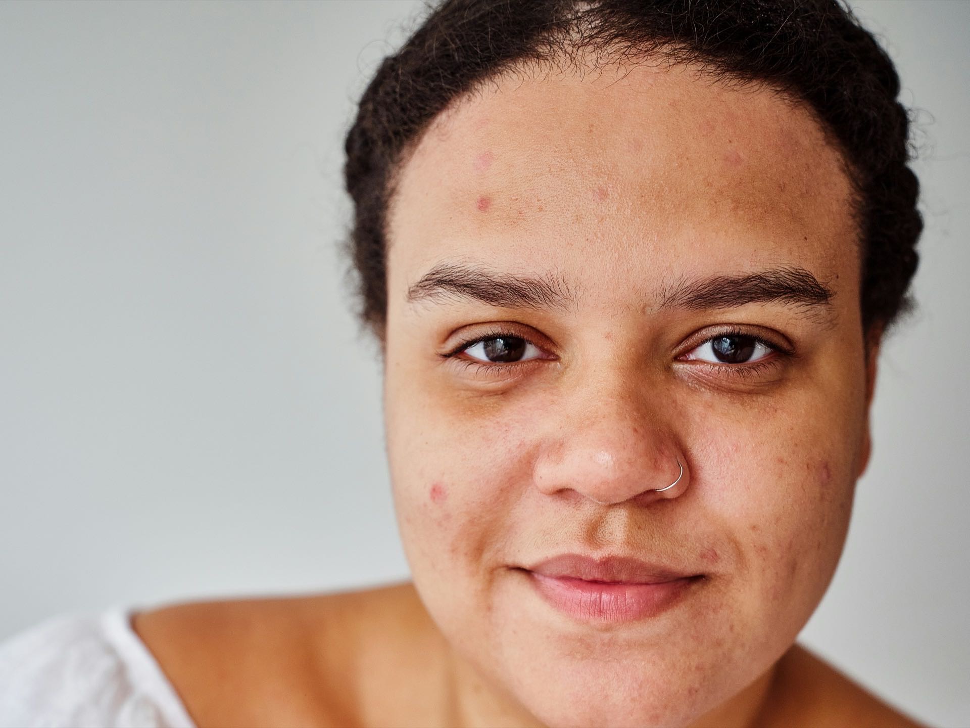 Acne treatment at Florida Aesthetics and Wellness Brandon FL
