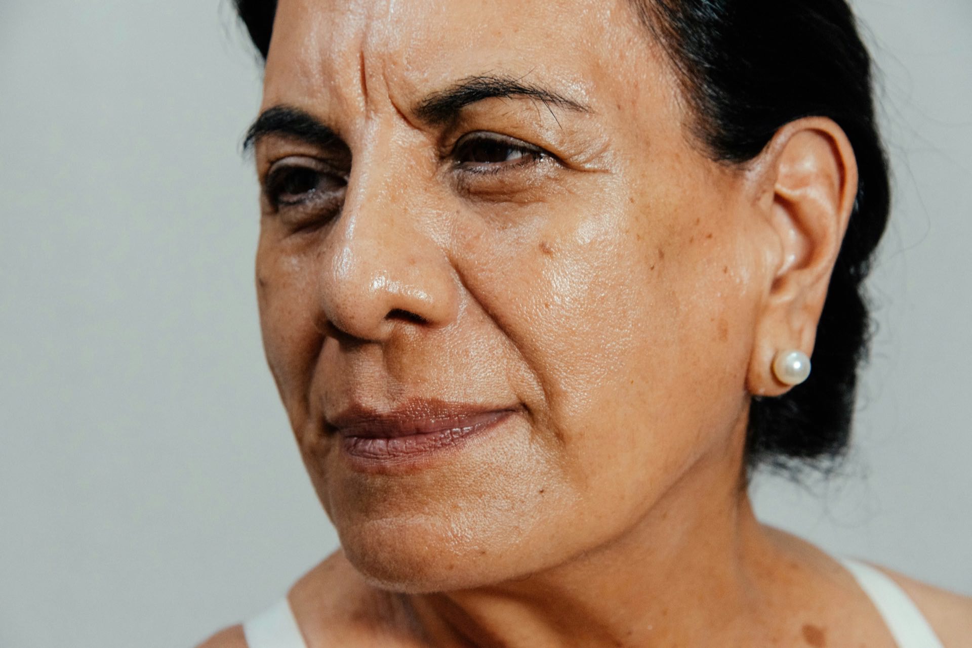 Hyperpigmentation treatment Brandon FL