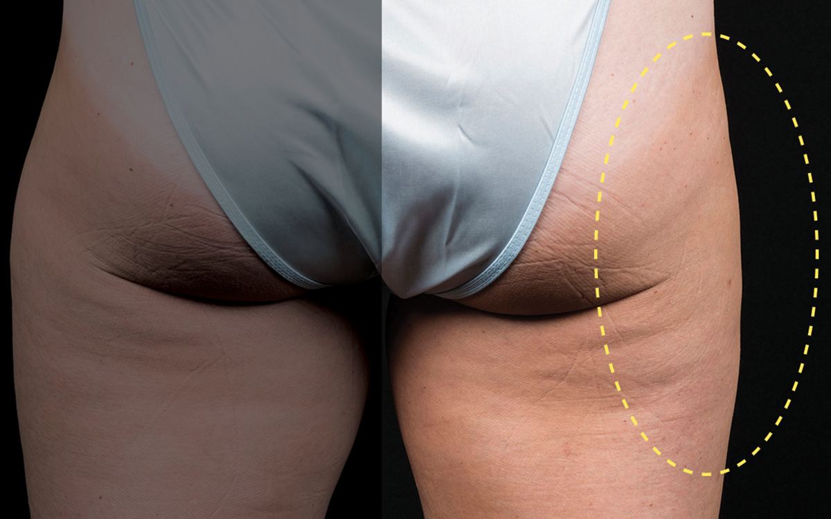 After CoolSculpting outer thighs