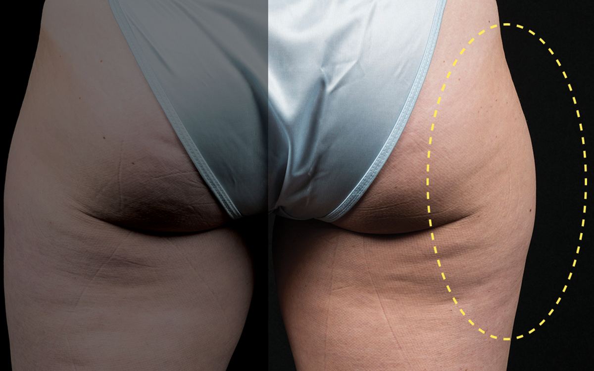Before CoolSculpting outer thighs