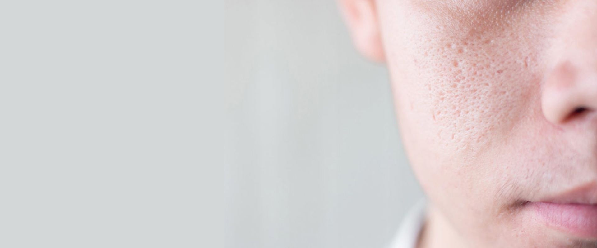 Enlarged pores treatment at Florida Aesthetics and Wellness Brandon FL