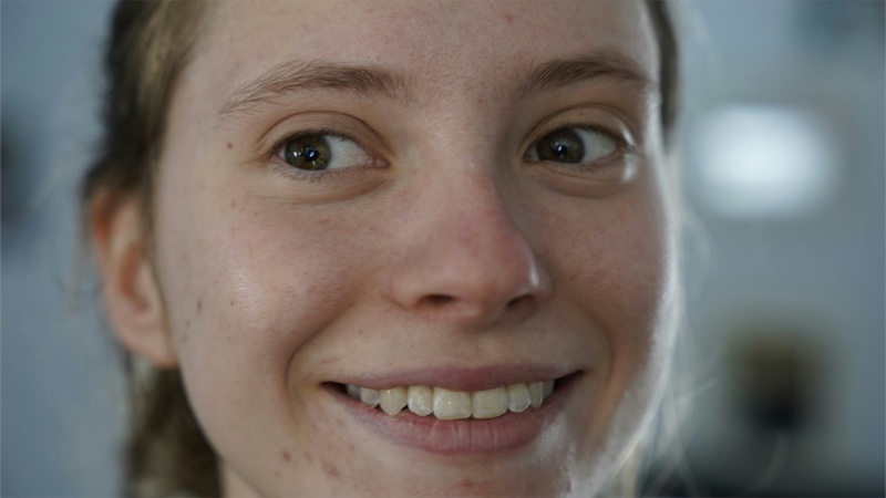 Freckles and dark spots treatment Brandon FL