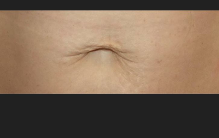 Before HALO Laser, fine lines and skin texture
