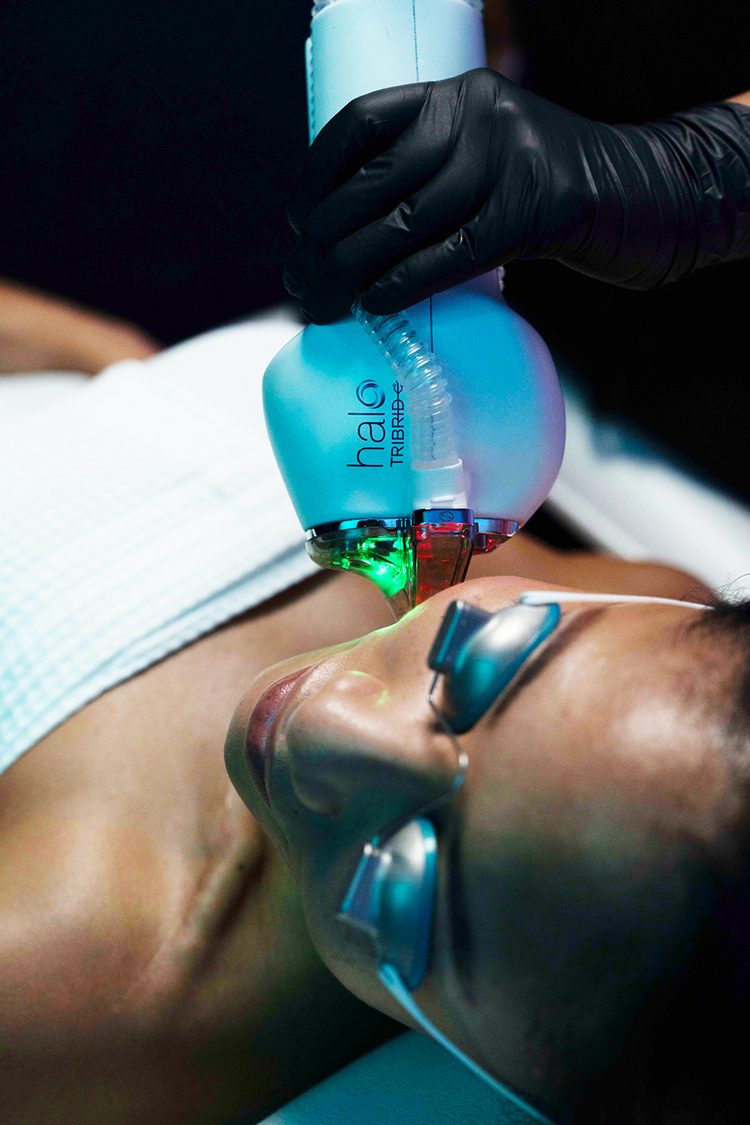 HALO laser treatment at Florida Aesthetics and Wellness Brandon FL