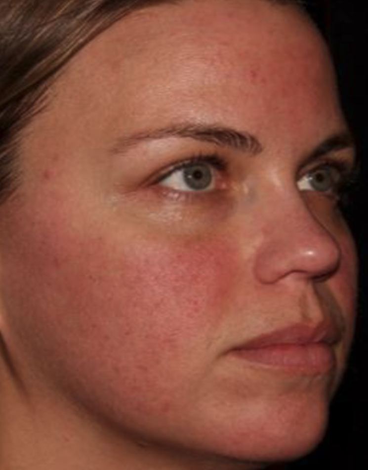 After HALO Laser, improved skin tone and texture