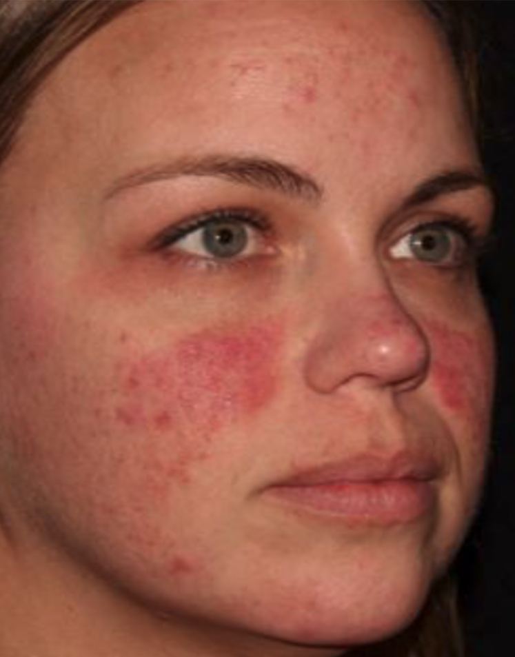 Before HALO Laser, redness and uneven skin tone