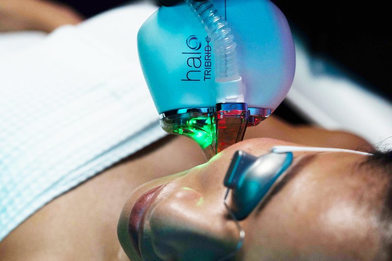 HALO laser resurfacing at Florida Aesthetics and Wellness Brandon FL