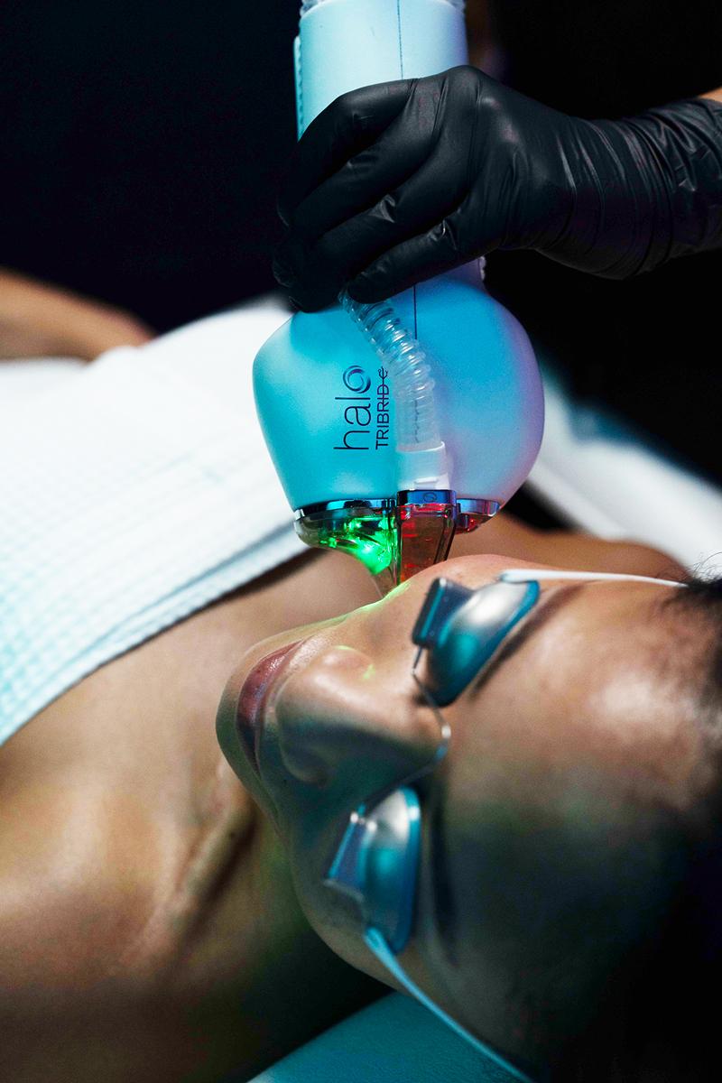 HALO Laser treatment experience