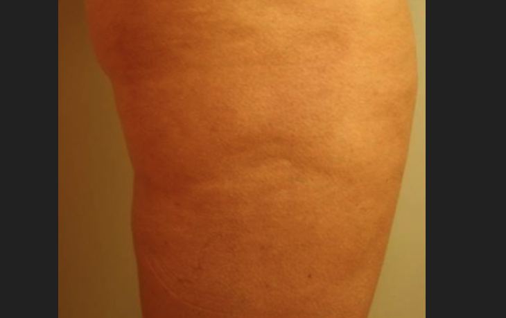 After HALO Laser, sun damage improvement