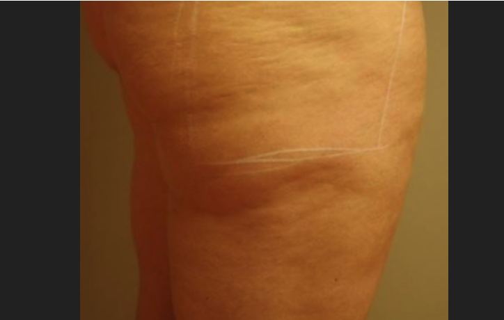 Before HALO Laser, sun damage and pigmentation