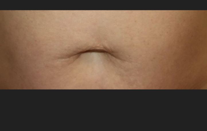 After HALO Laser, smoother skin texture