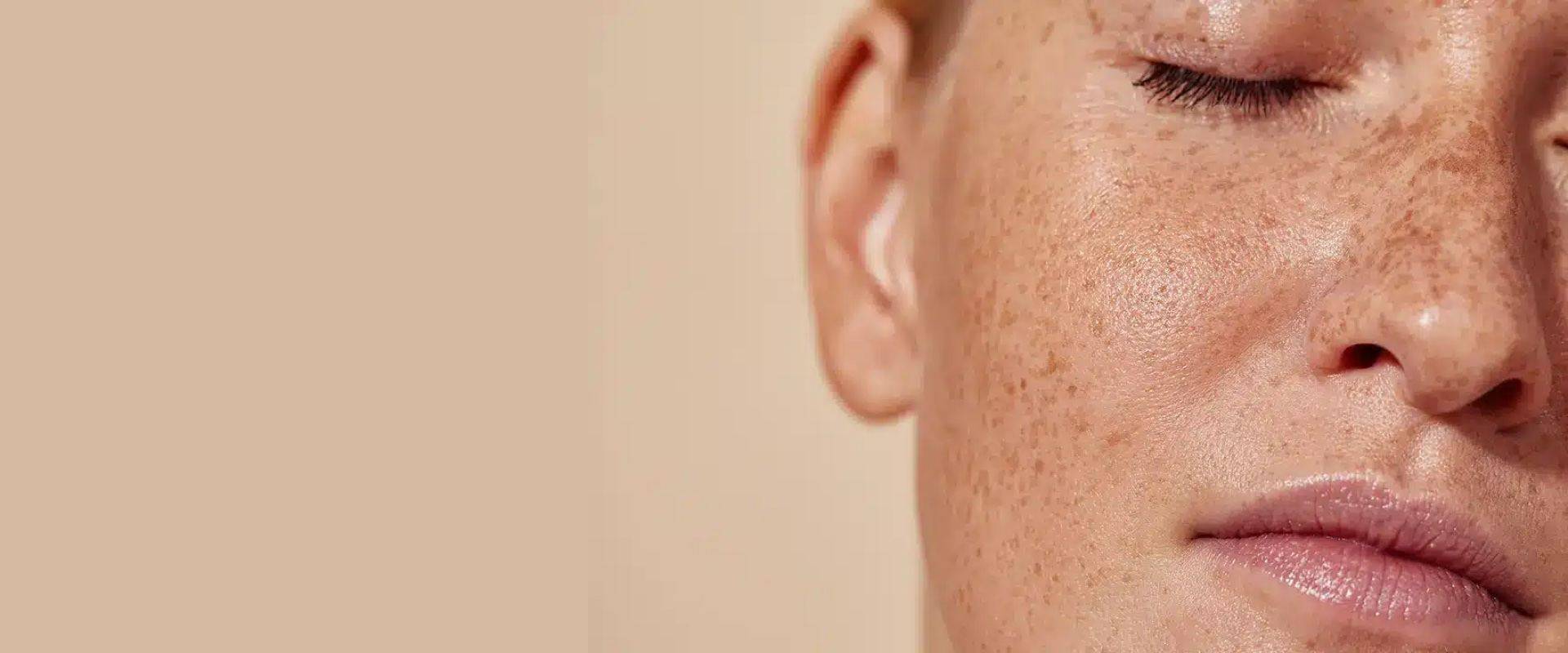 Concerns Sun Damage at Florida Aesthetics and Wellness Brandon FL