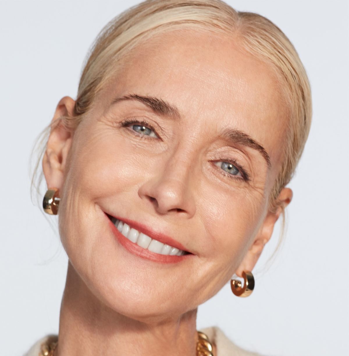Juvéderm Vollure XC, nasolabial folds and marionette lines