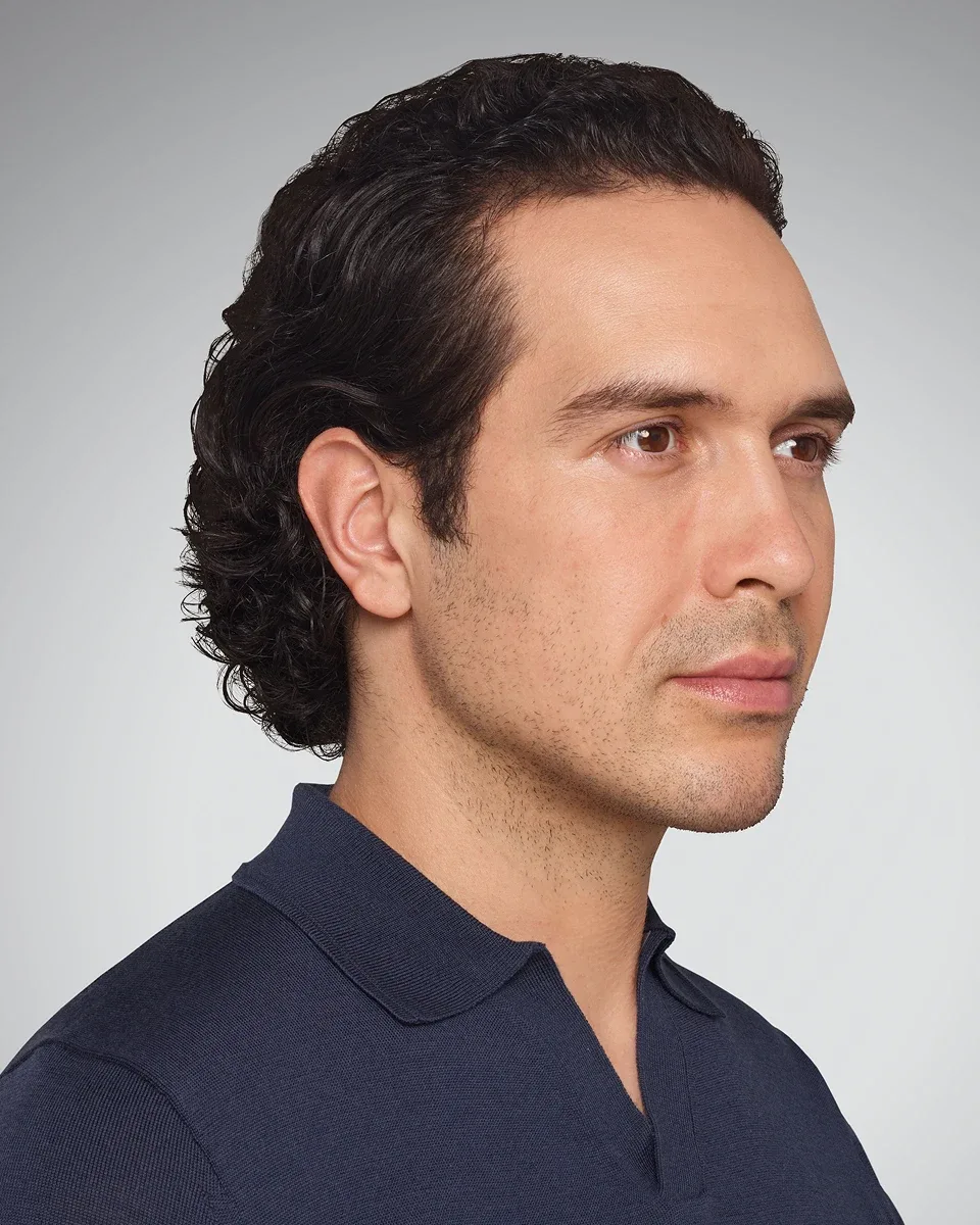Devin after Juvéderm Ultra Plus XC, deep nasolabial fold correction