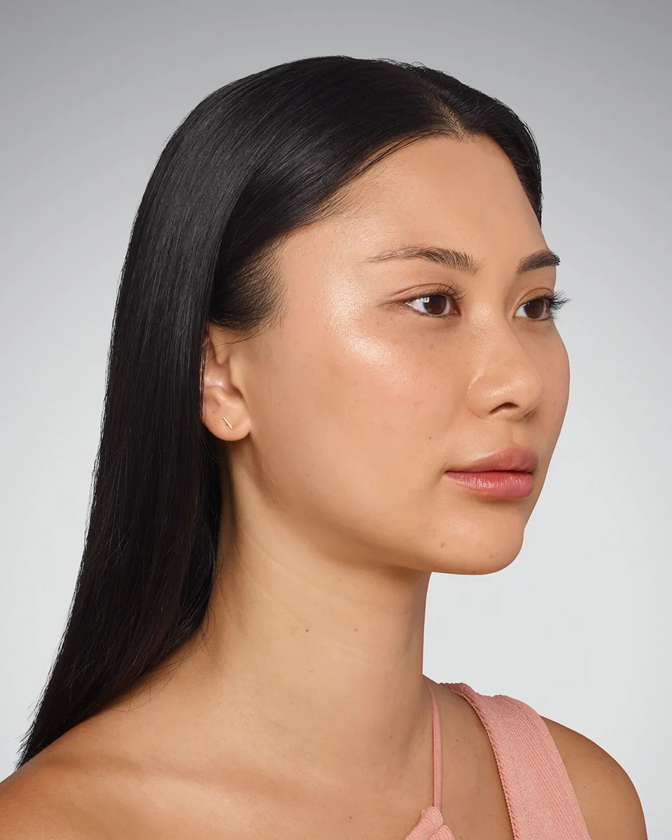 Sara after Juvéderm Ultra Plus XC, deep facial fold improvement