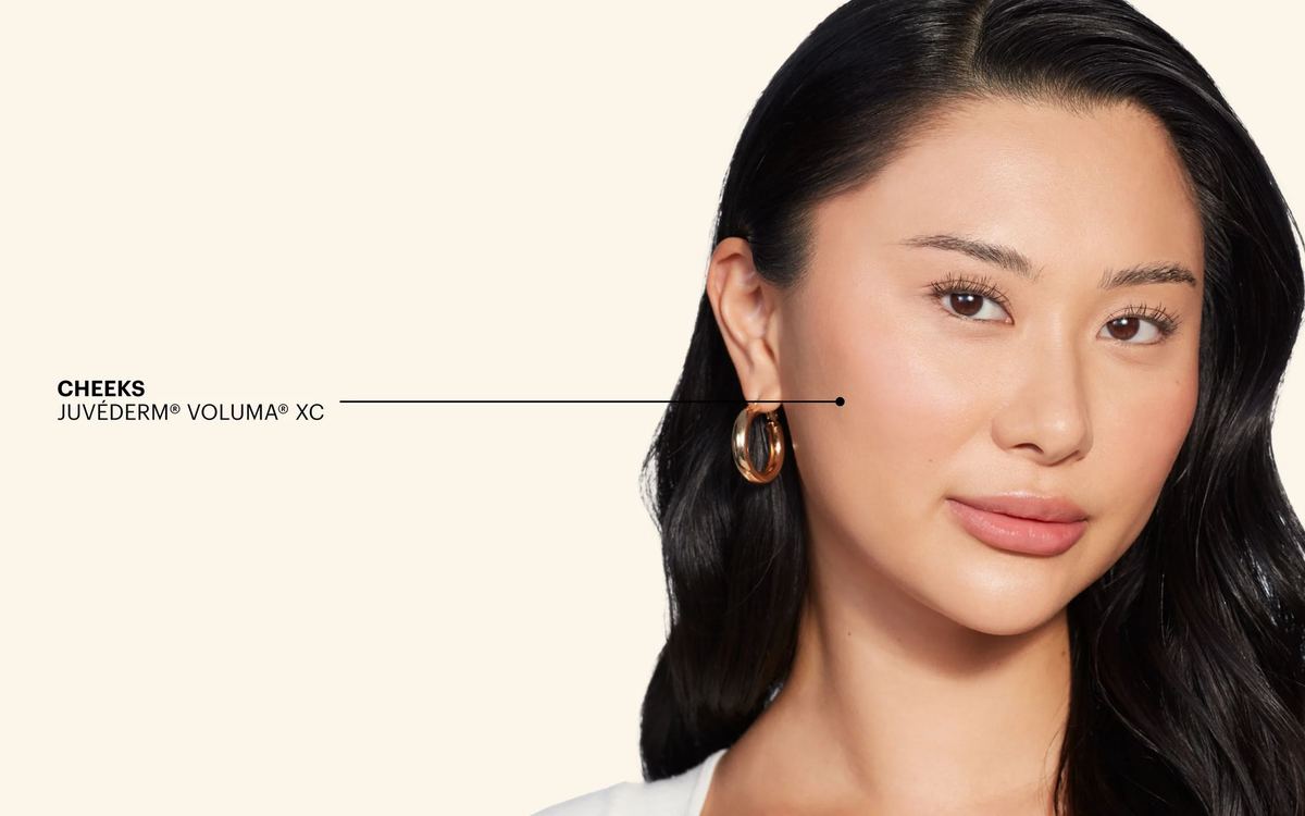 Cheek volume restoration with fillers
