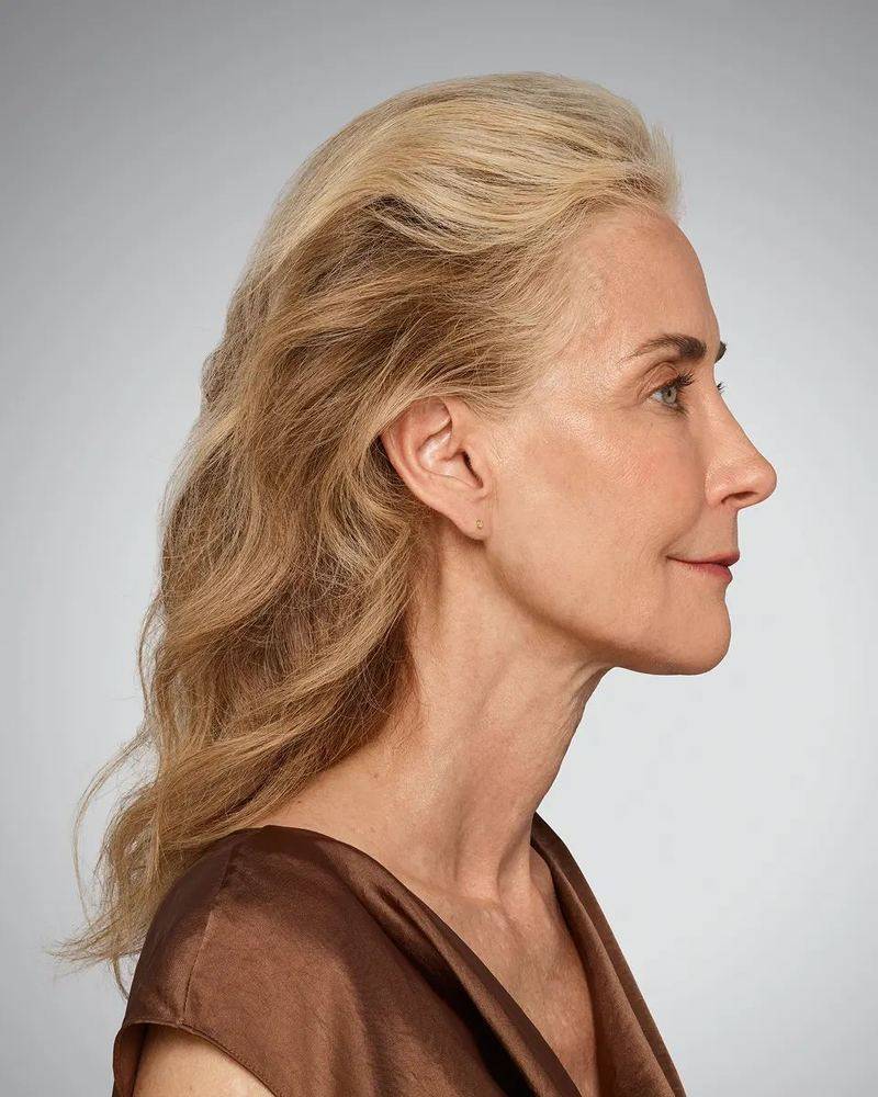 After Volux, defined jawline and neck