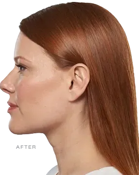 After KYBELLA®, submental reduction