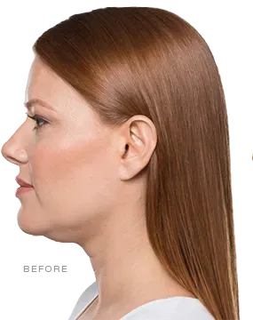 Before KYBELLA®, mild double chin