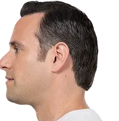 After KYBELLA®, defined chin profile