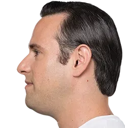 Before KYBELLA®, moderate submental fat