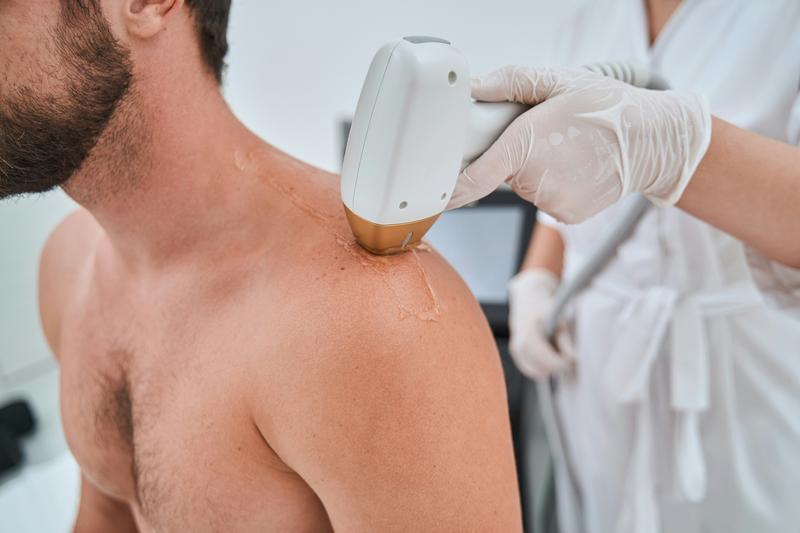 Laser hair removal for men at Florida Aesthetics and Wellness Brandon FL