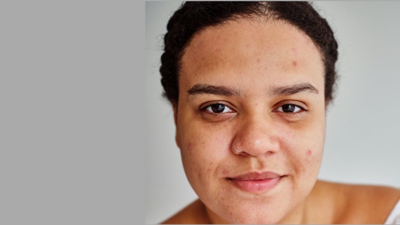 Melasma treatment Brandon FL