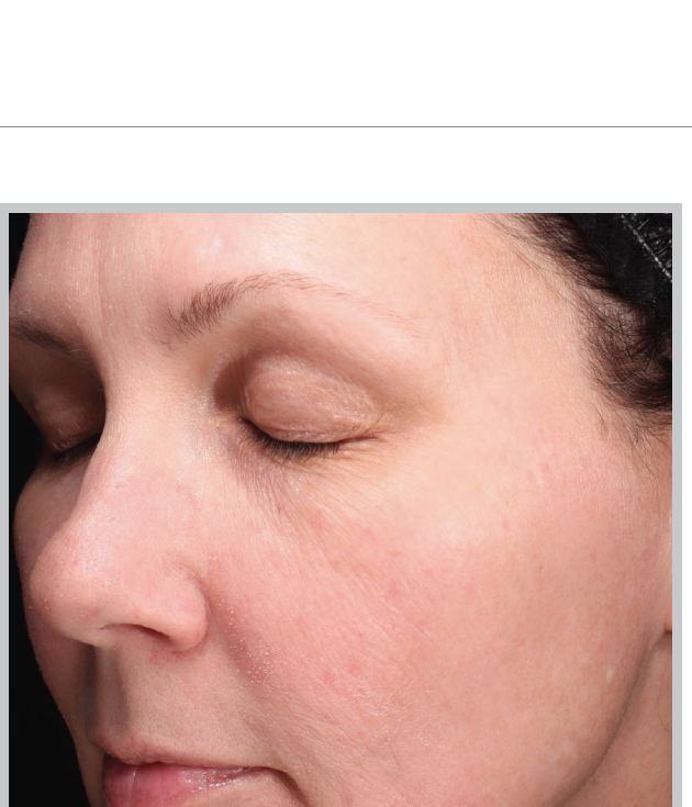 After MOXI, improved skin tone