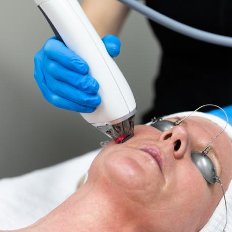 MOXI Laser treatment experience