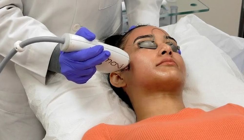 MOXI laser skin resurfacing at Florida Aesthetics and Wellness Brandon FL