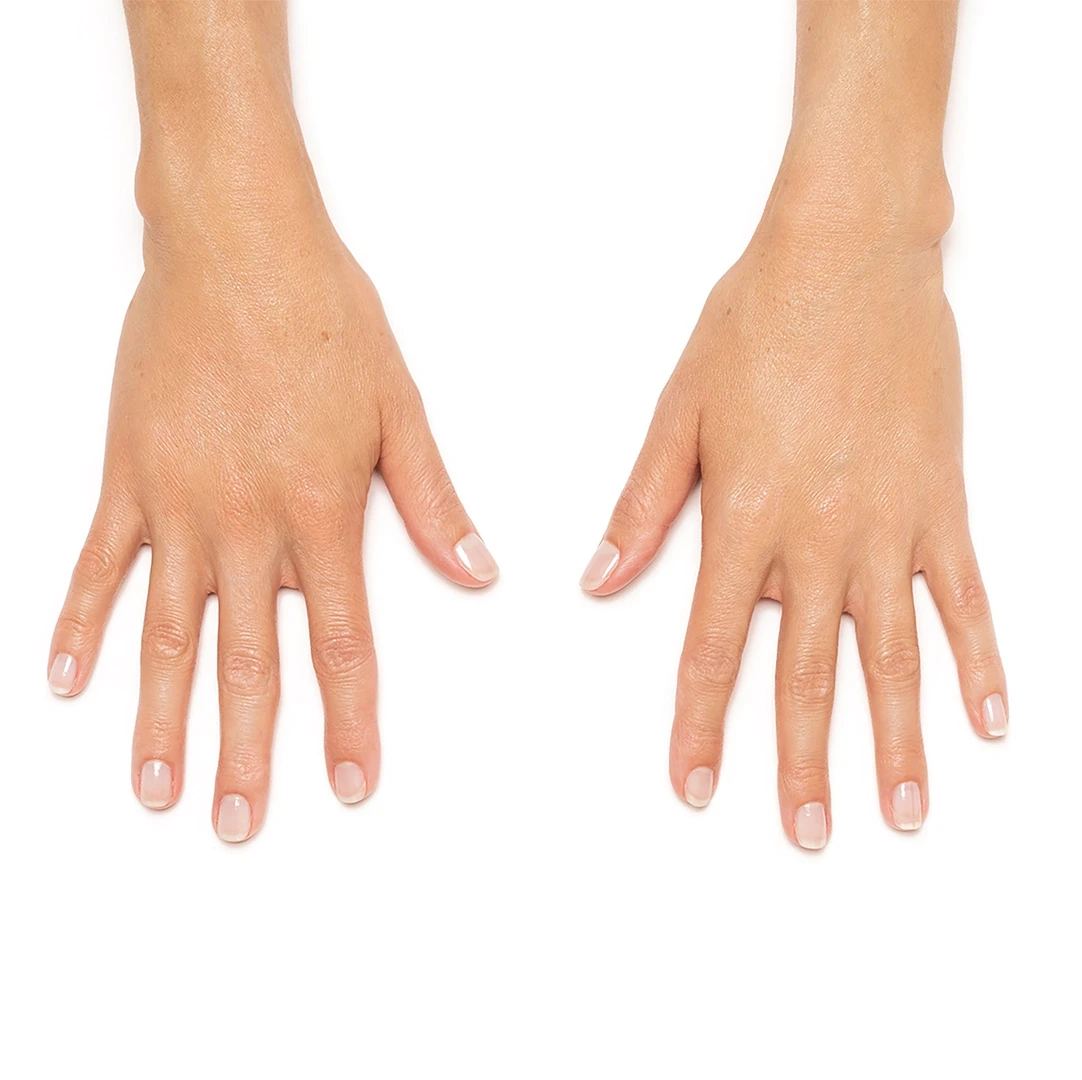 After RADIESSE® hand rejuvenation
