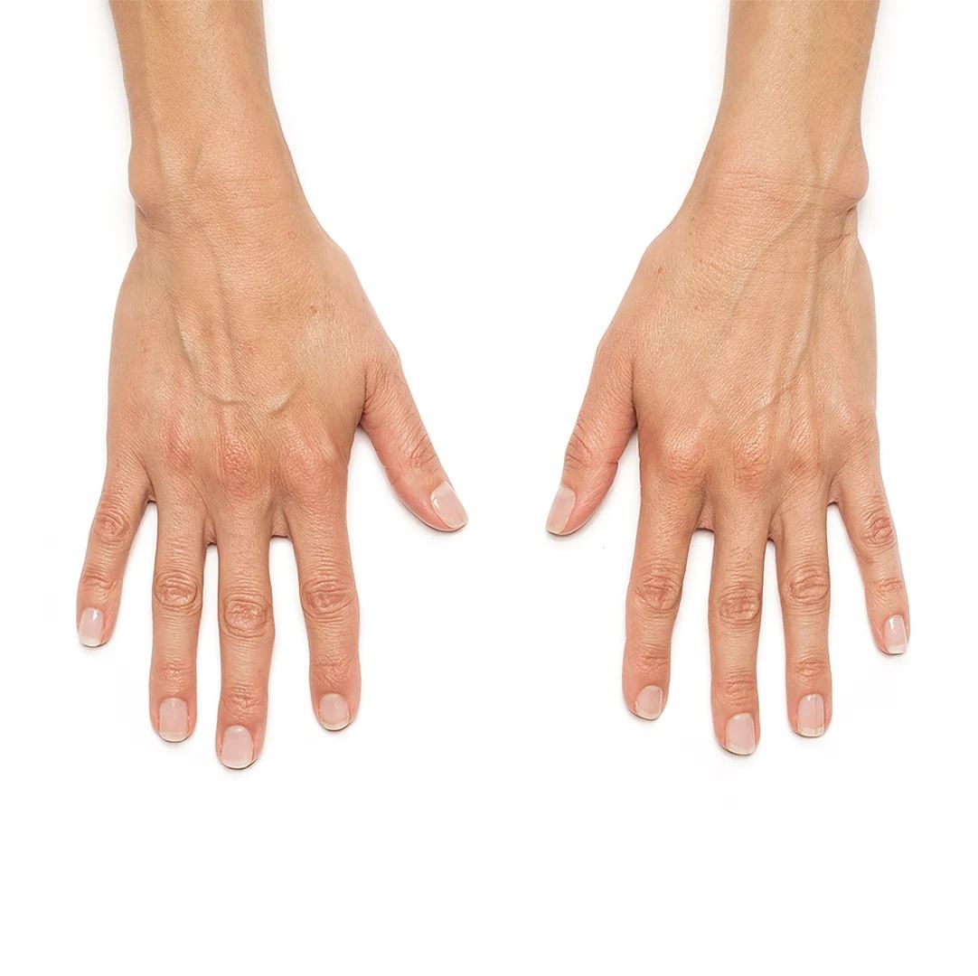 Before RADIESSE® hand rejuvenation