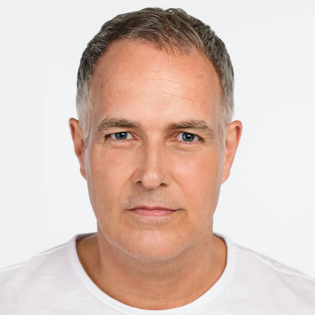 Before RADIESSE® jawline treatment