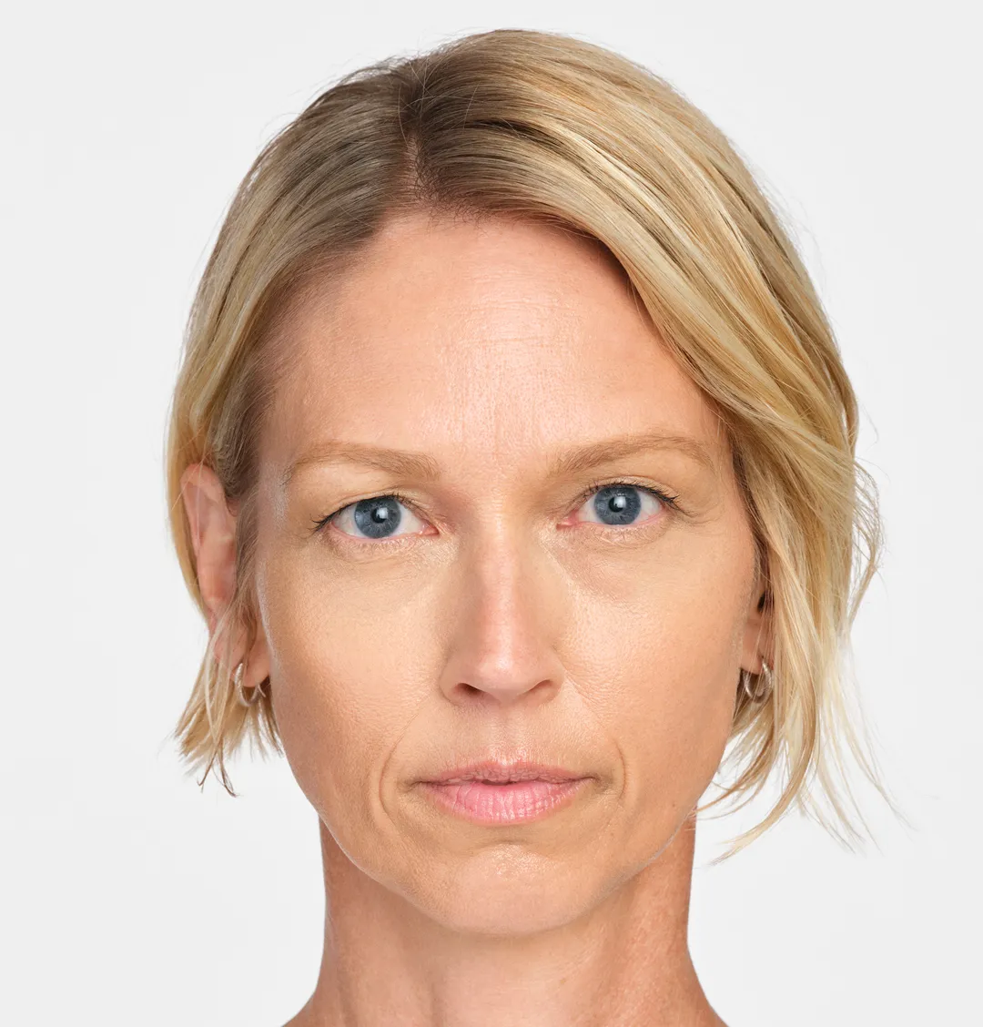 After RADIESSE® nasolabial folds