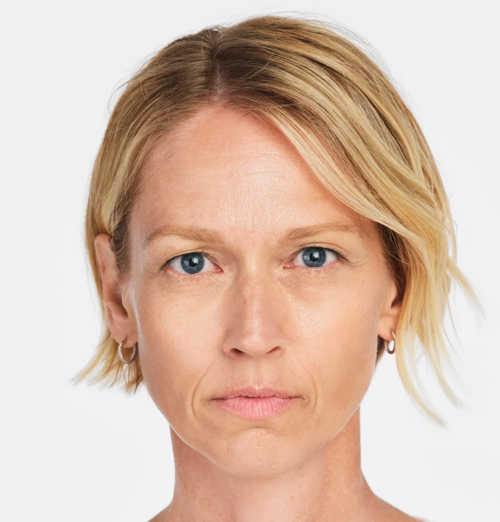 Before RADIESSE® nasolabial folds