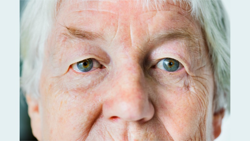 Rosacea treatment Brandon FL