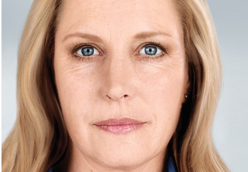 After Sculptra® Aesthetic, restored facial volume and collagen