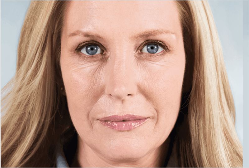 Before Sculptra® Aesthetic collagen treatment
