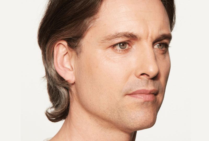 After Sculptra® Aesthetic, restored collagen and midface volume