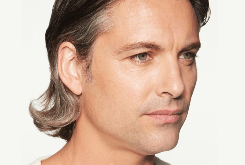 Before Sculptra® Aesthetic, male facial volume loss