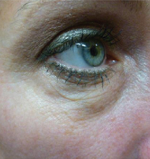 After SkinTyte  -  tightened under-eye area