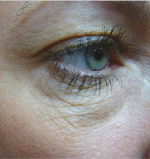 Before SkinTyte  -  under-eye laxity