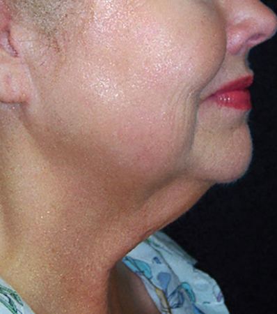After SkinTyte  -  tightened jaw and neck