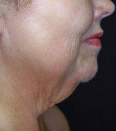 Before SkinTyte  -  jaw and neck laxity