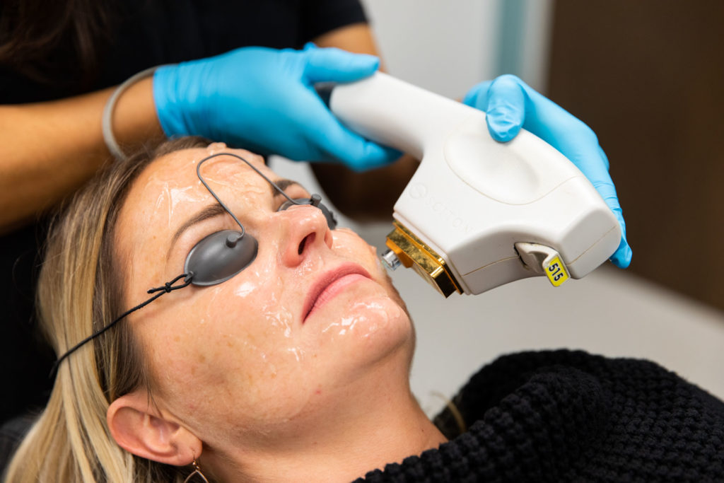 SkinTyte non-invasive skin tightening at Florida Aesthetics and Wellness Brandon FL