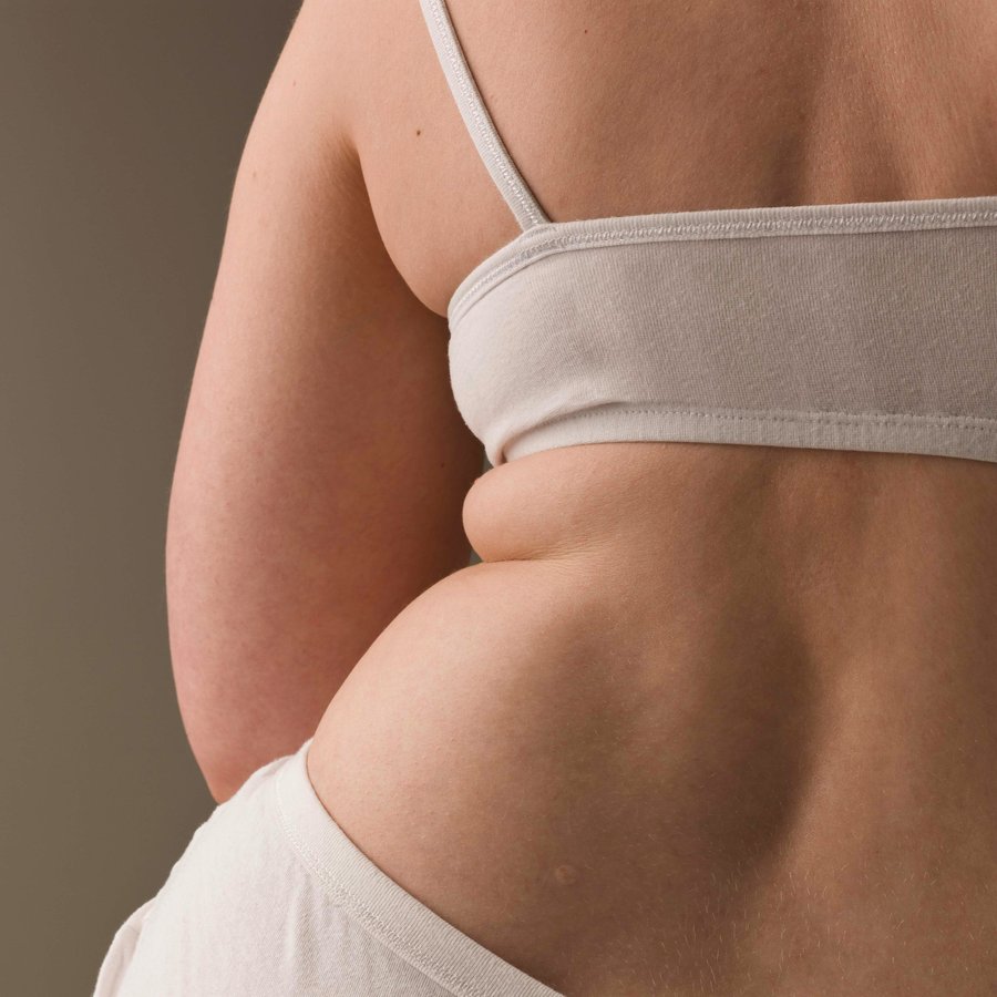 Stubborn fat treatment at Florida Aesthetics and Wellness Brandon FL