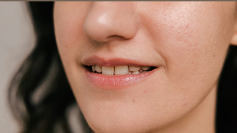 Lip filler thin lips Brandon FL